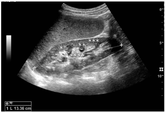 健康・医学 ATLAS OF Renal Ultrasonography O'NEILL Kidney Ultrasound Images: Normal and Abnormal (2026)