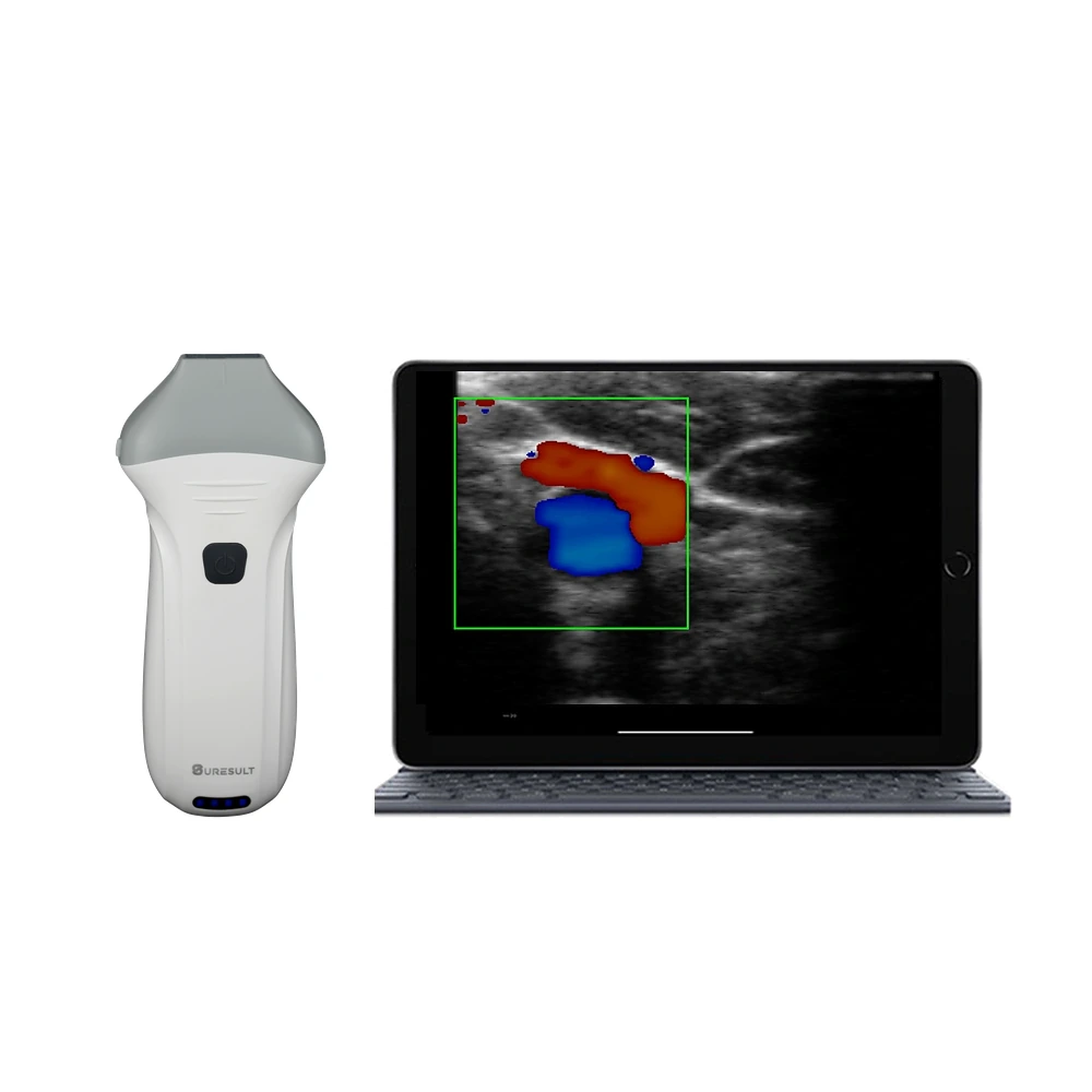 Buy Primary Care Portable Ultrasound - Suresult