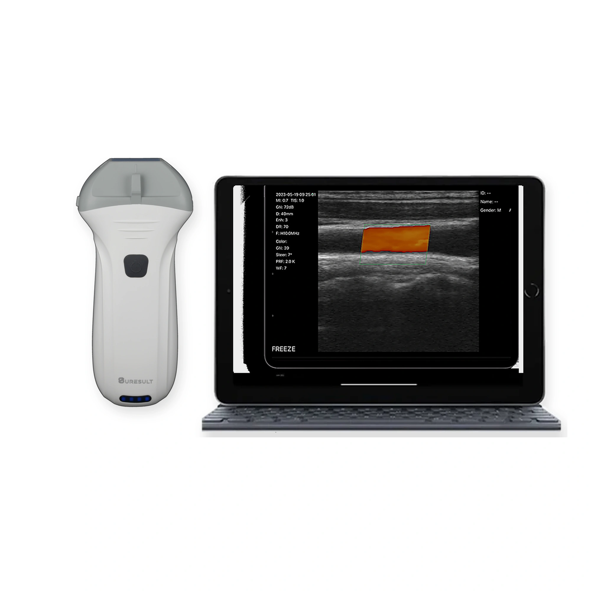 Sonda de ecografía lineal portátil Suresult L14Pro de 10/14 MHz con pantalla de tableta para Doppler vascular