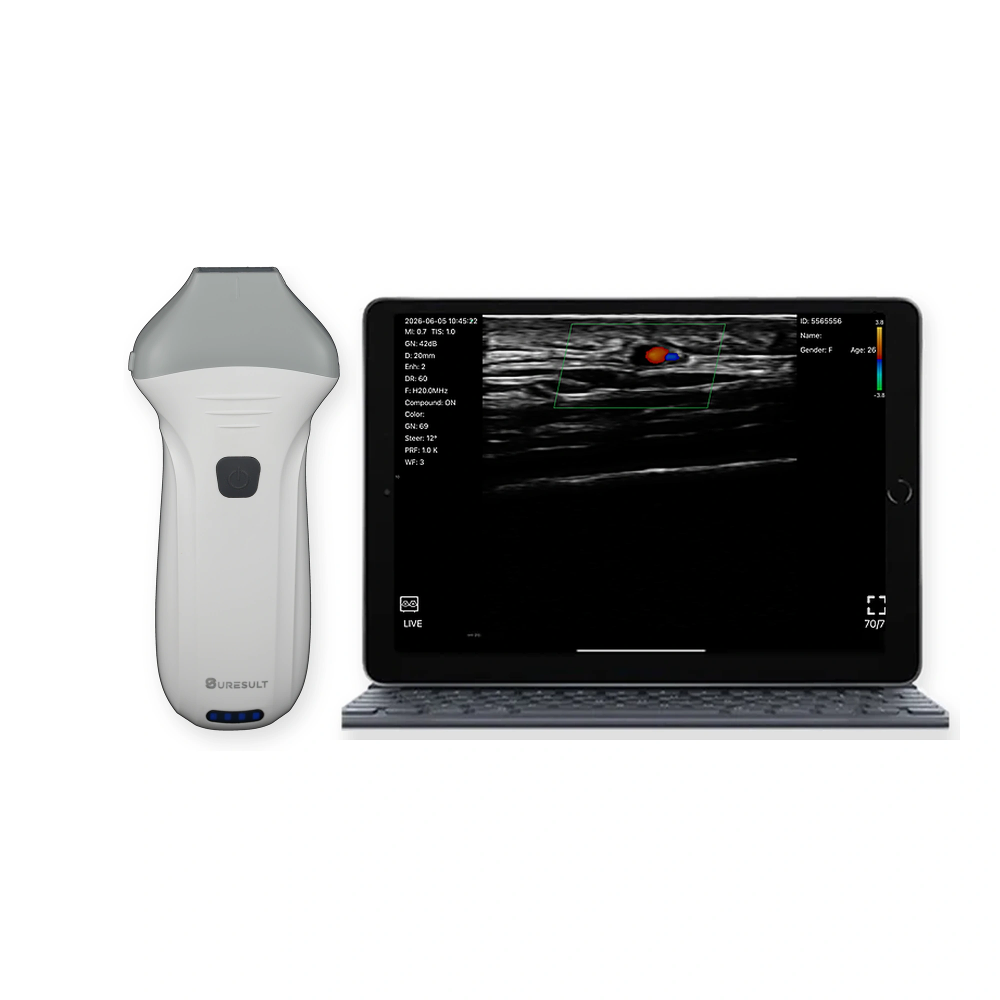 Sonda de ecografía lineal portátil Suresult L20Pro de 16/20 MHz con pantalla de tableta con Doppler en color